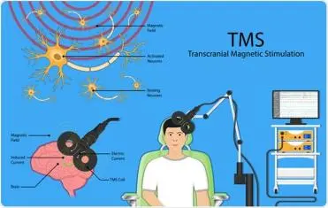 transcranial magnetic stimulation(TMS) technology