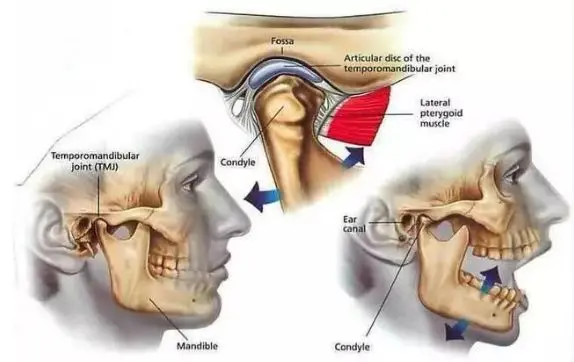 temporomandibular joint disorder syndrome