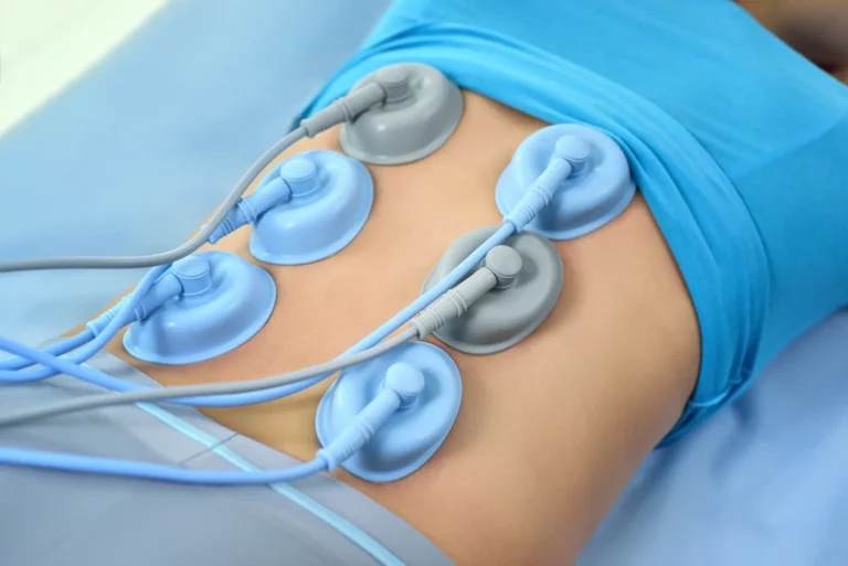 Interferential Stimulation