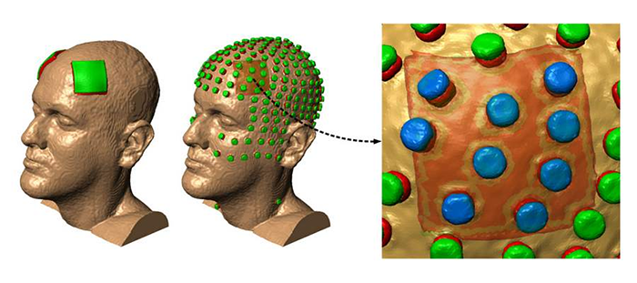Parkinson's Disease